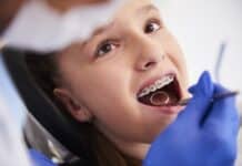 Maintaining Oral Hygiene with Braces