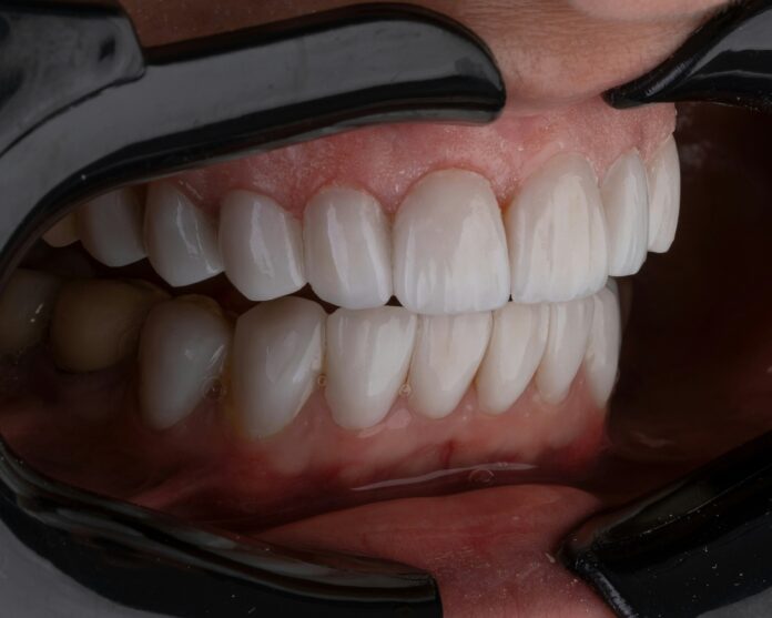 Veneers Veneers
