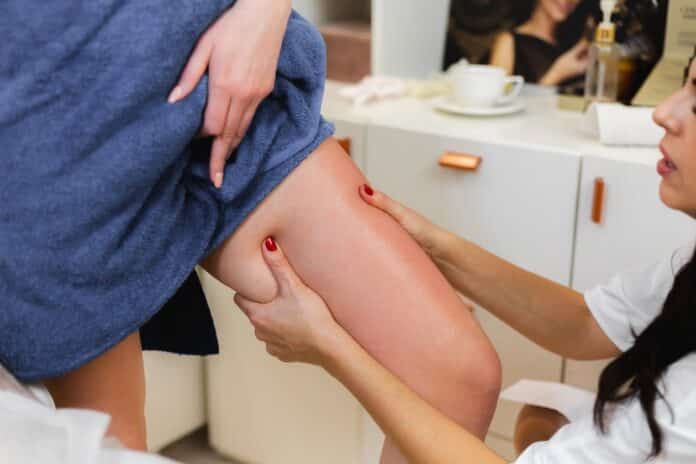 Lymphedema